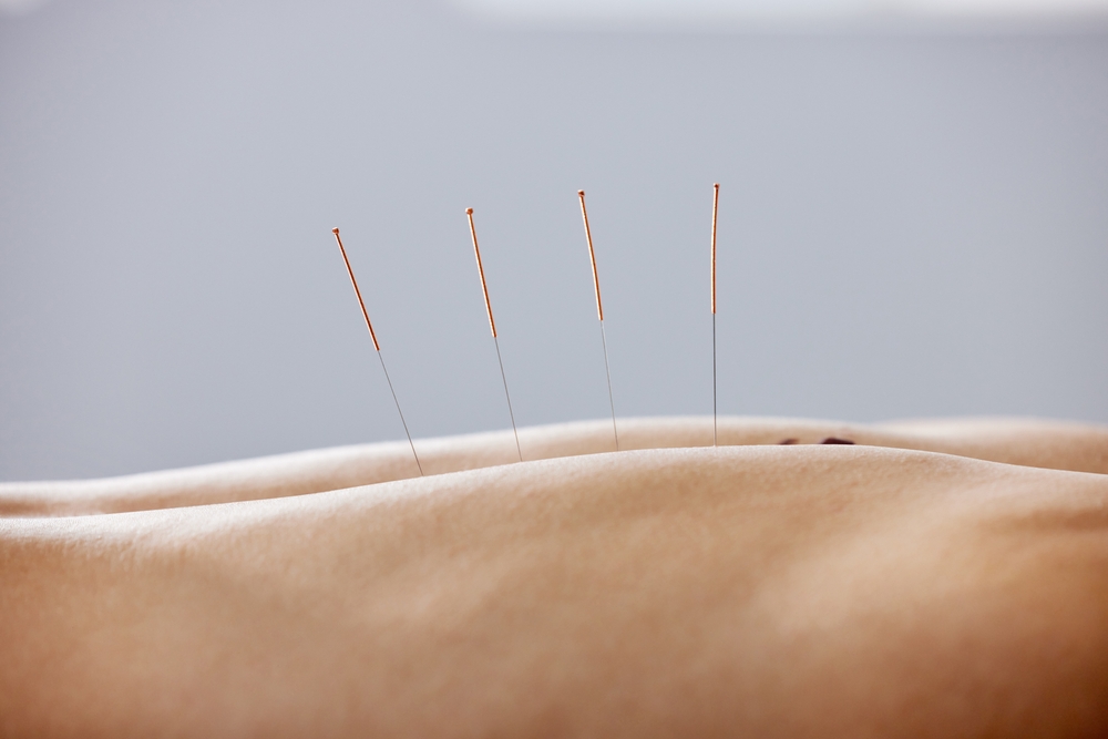 patient receiving acupuncture in north vancouver