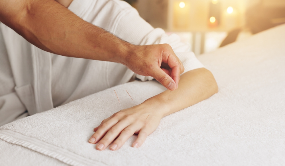 woman receiving hand acupuncture in north vancouver